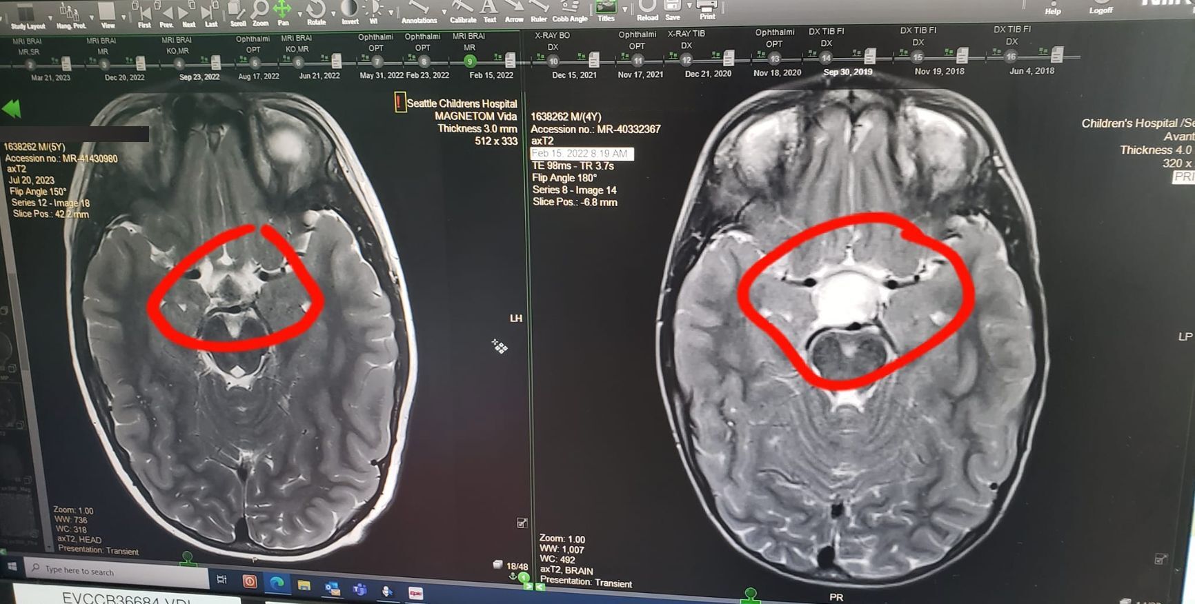 An image of two MRI scans