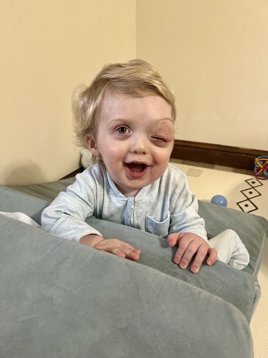 Young child with a swollen eye, wearing a light blue outfit, smiling while leaning on a cushion.