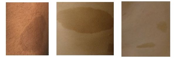 Three close-up images of skin, each showing flat, light brown patches of varying sizes and shapes on different skin tones.